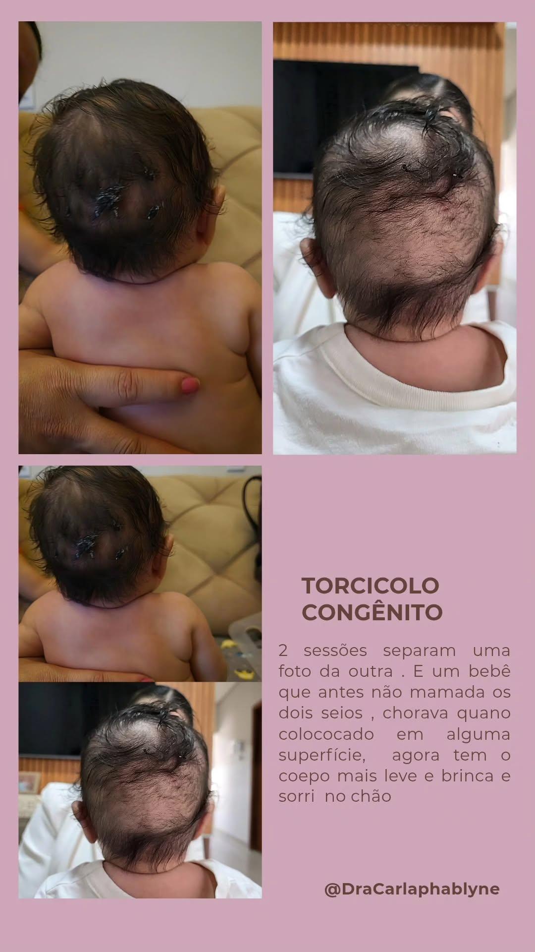 Bebê com o pescoço em destaque e texto sobre assadura