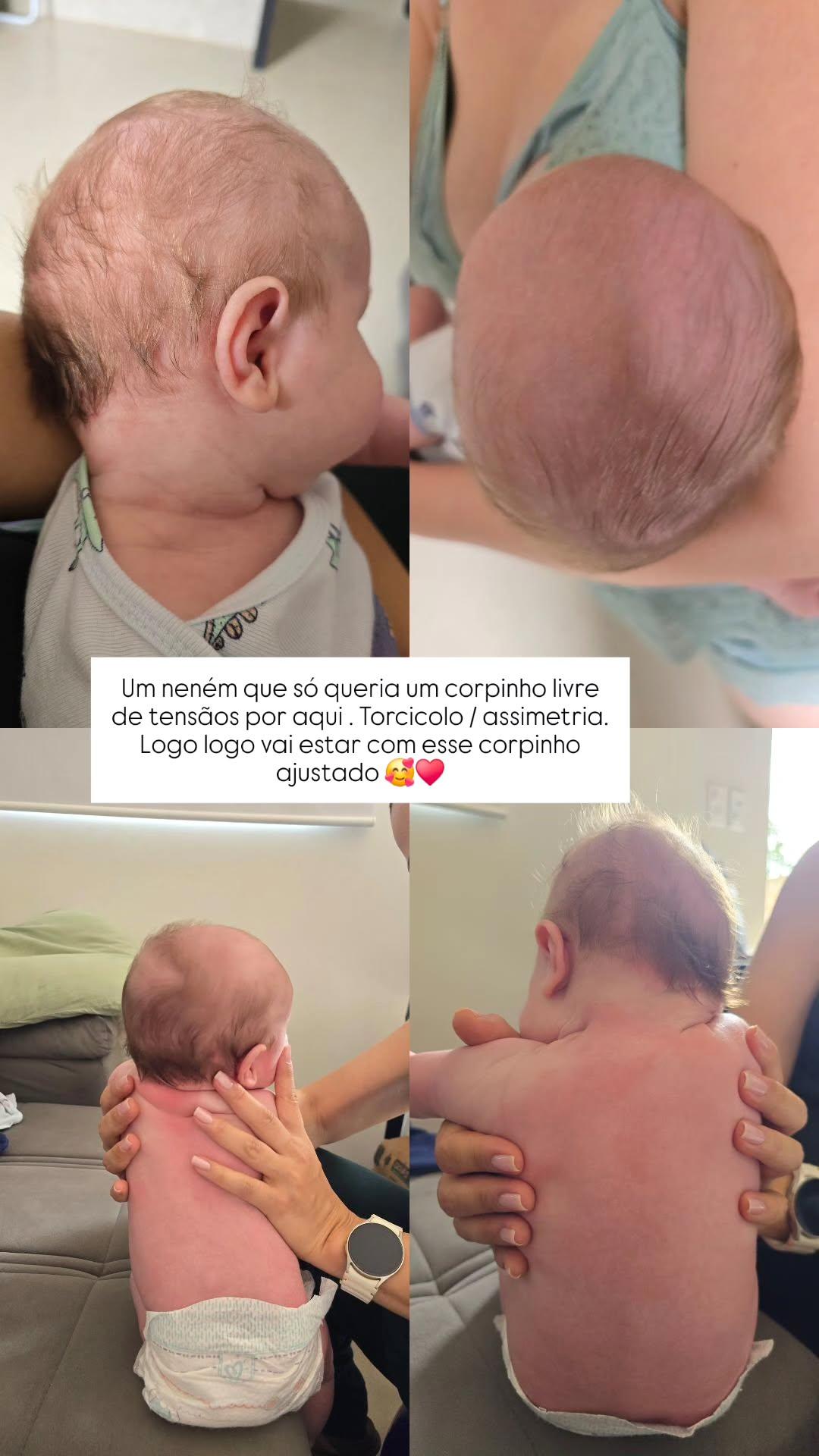 Colagem com 4 fotos de torcicolo/assimetria com as mãos da Dra. Carla
